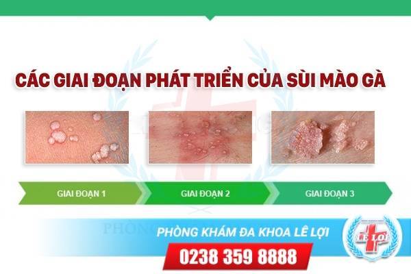 Những hình ảnh giúp nhận biết các giai đoạn bệnh sùi mào gà