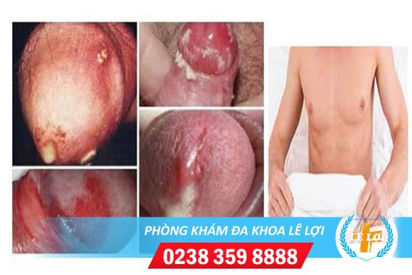 Bệnh lậu ở nam giới: triệu chứng & cách phòng ng