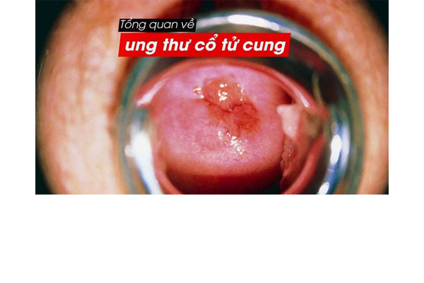 ung-thu-co-tu-cung